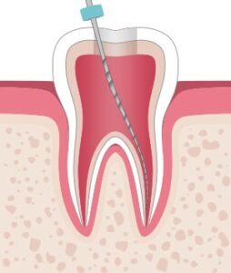 Zahnarztpraxis Aksoy - Endodontie in Wuppertal - Wurzelkanalbehandlung
