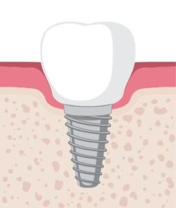 Zahnarztpraxis Aksoy - Implantologie und Prothetik in Wuppertal - Zahnimplantate und Zahnersatz
