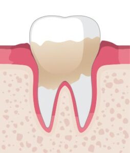 Zahnarztpraxis Aksoy - Parodontologie in Wuppertal - Behandlung des Zahnfleisches